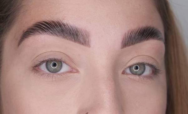 Eyebrow Lifting Botox Injection for Eyebrow Lift