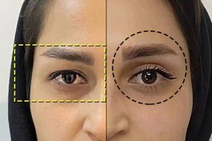Eliminate droopy eyelids in just one session! Scar-free and in the finest clinic