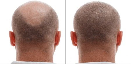 Limitations of hair transplant for special patients Limitations of hair transplant for special patients