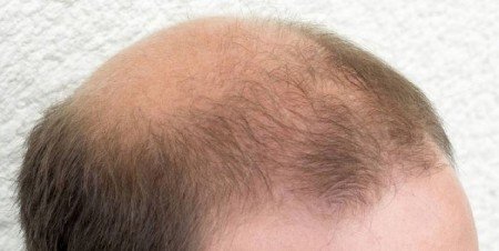 Safety of hair transplant for skin patients Safety of hair transplant for skin patients