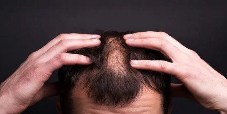 Hair transplant and hormonal issues Hair transplant and hormonal issues
