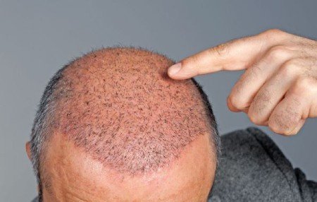Hair transplant for individuals with special diseases Hair transplant for individuals with special diseases