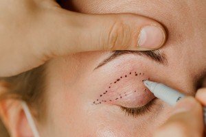 Eliminate droopy eyelids in just one session! Scar-free and in the finest clinic