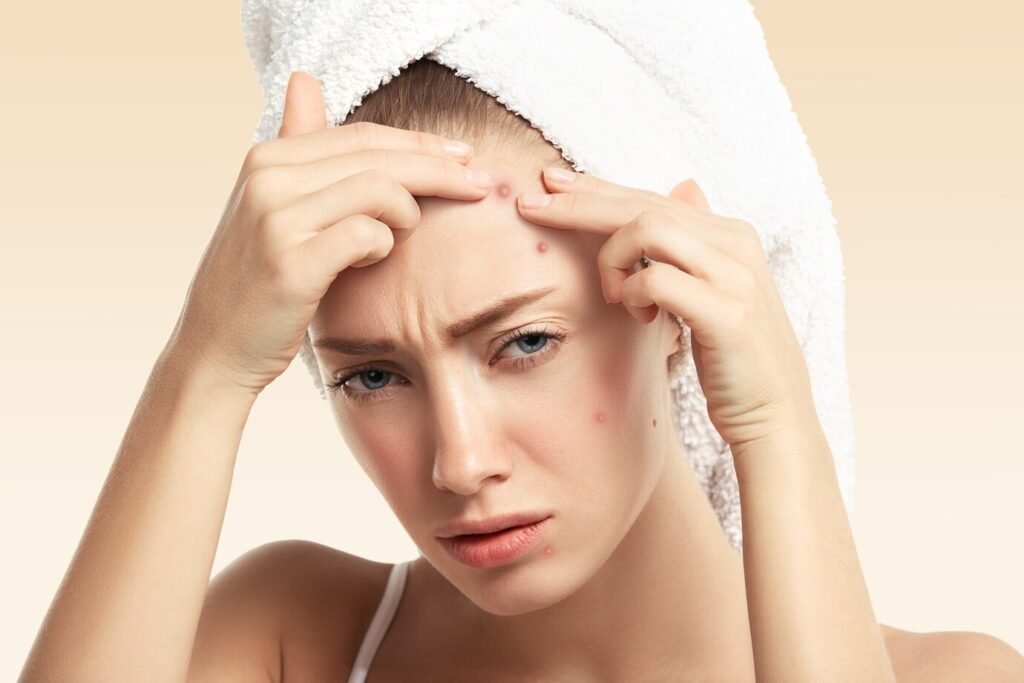 Stress Related Skin Issues: Acne and Breakouts