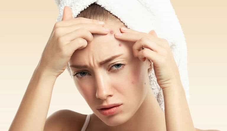 Acne Acars Treatments